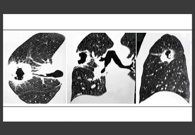 中医治疗肺癌有效吗?