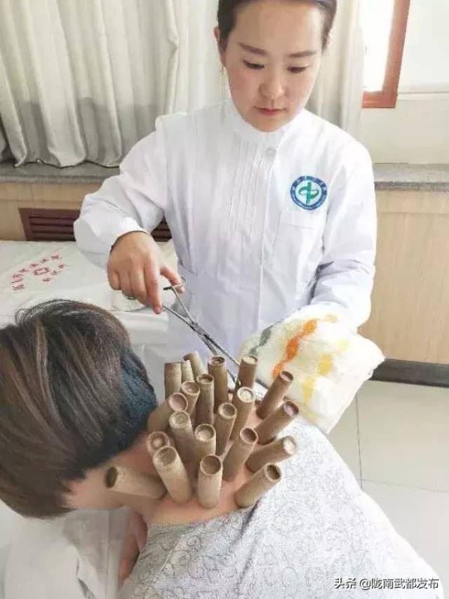 武都区中医院针灸优势病种科开展的中药竹罐疗法.