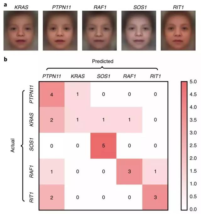 在另一组试验中,研究人员选取努南综合征(noonan syndrome,是一种