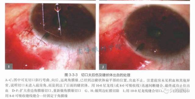 周边虹膜切除术相关问题解答 part4 | 《图解青光眼手术操作与技巧》