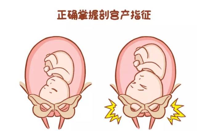 该不该选择剖宫产?这里面的利弊,不能只有医生知道.