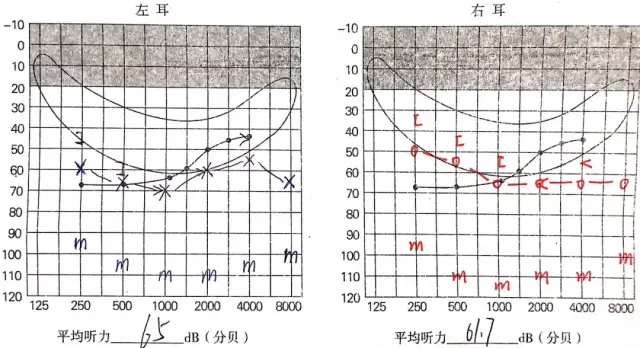 耳硬化症的听力学诊断与干预