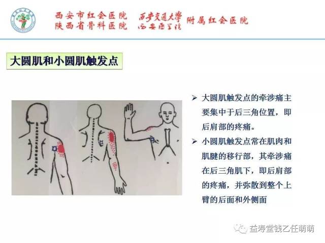 颈背部疼痛的肌筋膜触发点冲击波疗法