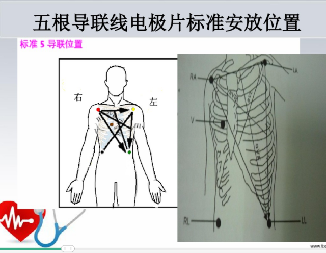 (三)使用心电监护仪时各电极安放的位置 有五个电极安放位置如下.