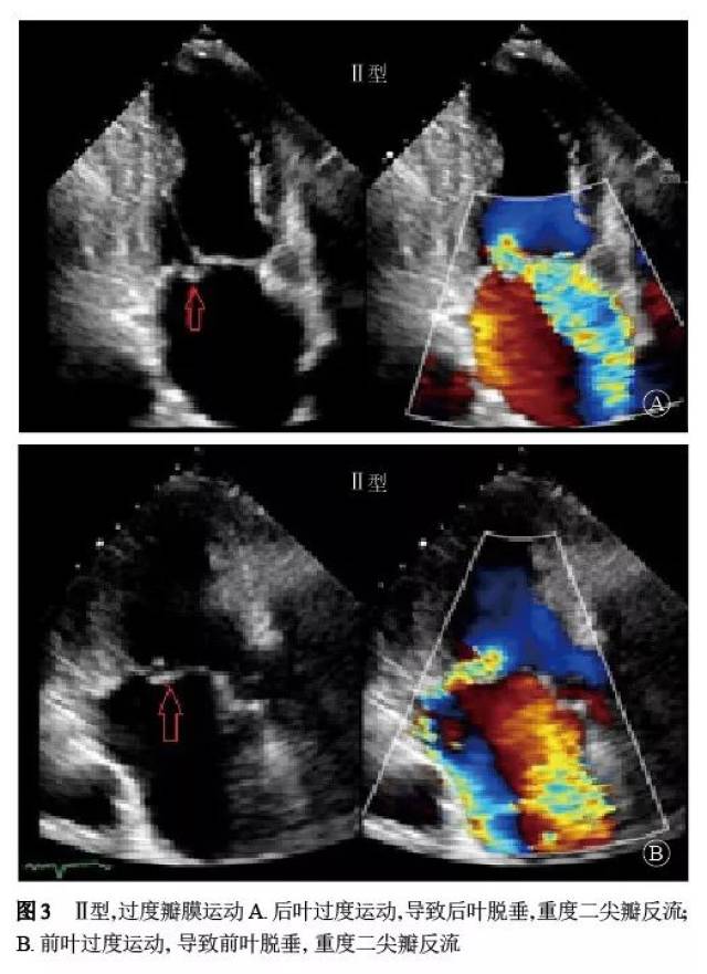 二尖瓣反流介入治疗的超声心动图评价中国专家共识