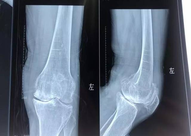 【医疗技术】四一七医院骨科近期完成多例髋膝关节置换术