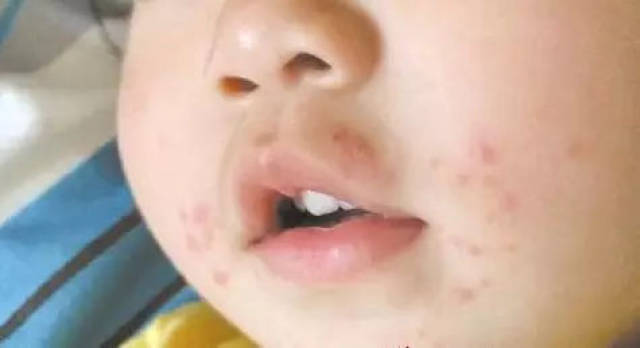 宝宝嘴巴周围起红疹是怎么回事可能是4个原因在作怪!