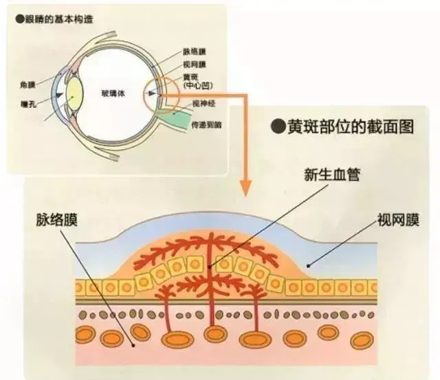 关于湿性老年性黄斑病变治疗的一些问题