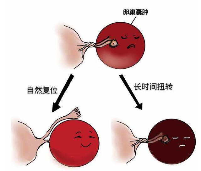 孕晚期突发腹痛:当心卵巢肿瘤扭转