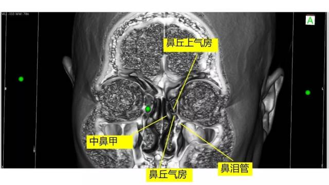 赵天智副教授 :前床突磨除与脑脊液漏处理---中鼻道经筛入路解剖