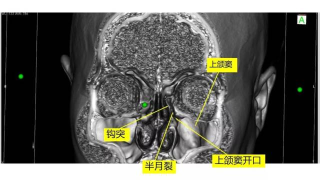 【正海-妙术视界】| 赵天智副教授 :前床突磨除与脑脊液漏处理---中鼻