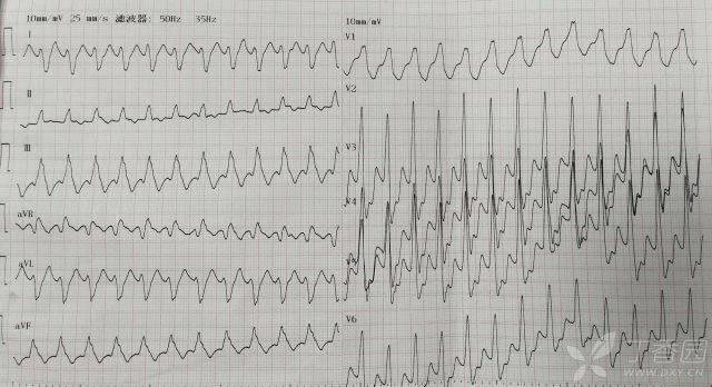 1. 室速发作时的心电图