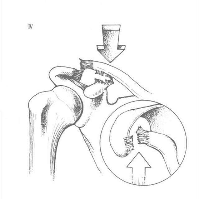 肩锁韧带断裂伴随喙锁韧带的不完全损伤; 肩锁关节间隙增宽,肩胛骨内