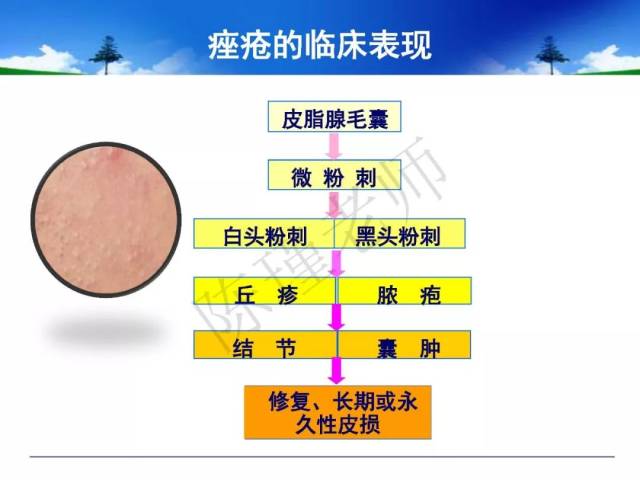 jaad微课堂(四十二)| 痤疮的分级治疗及治疗进展