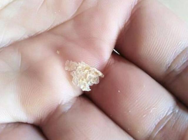 洗完头就有头屑?我长了3年的头屑,最后成了"头皮脂溢性皮炎"