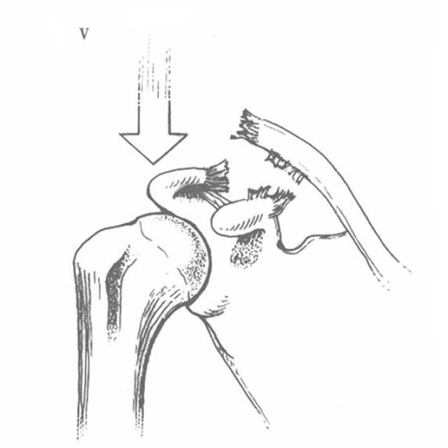 肩锁韧带与喙锁韧带全断裂; 喙锁间隙比正常时大25%-100%或4mm的距离