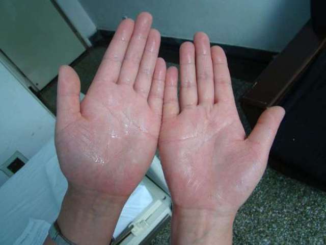 手脱皮是什么原因是缺什么维生素吗