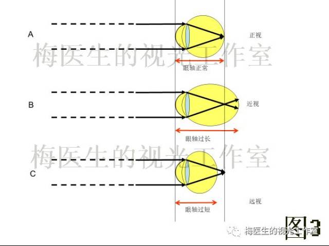 眼球对光的曲折能力过强,焦点落在视网膜前形成近视 c 角膜曲率过平时