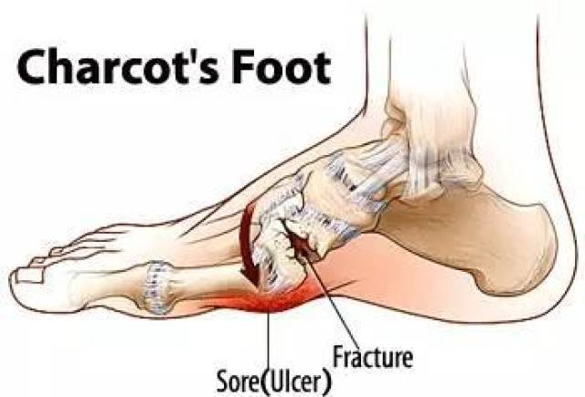 什么是夏科氏足(charcot foot)?