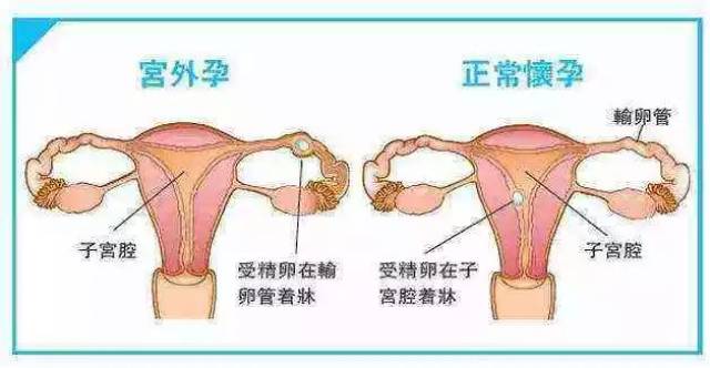 孕卵在子宫腔外着床发育的异常妊娠过程,以输卵管妊娠最常见.