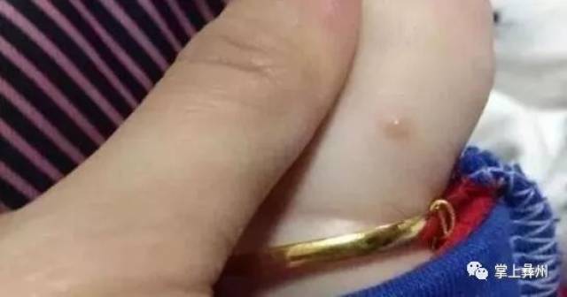 四川最新传染病疫情发布!这5种病西昌人要当心!