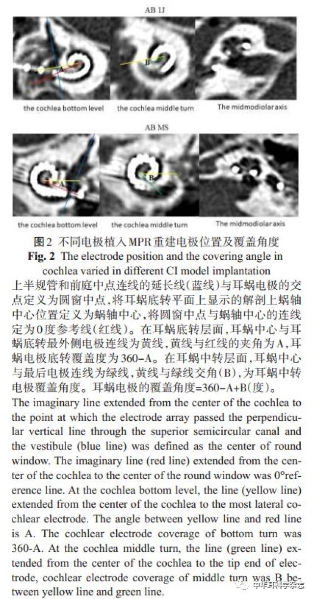 2.2 本研究耳蜗植入后耳蜗内精细结构情况