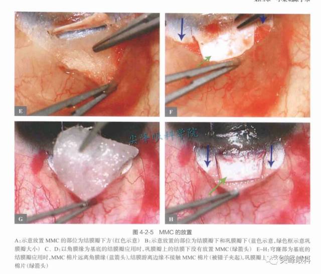 小梁切除术的手术技术和其它问题解答 part2 | 《图解