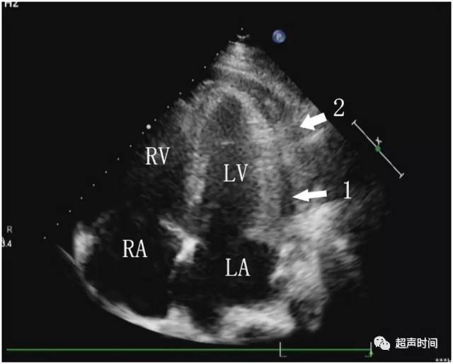 超声新手福利:缩窄性心包炎