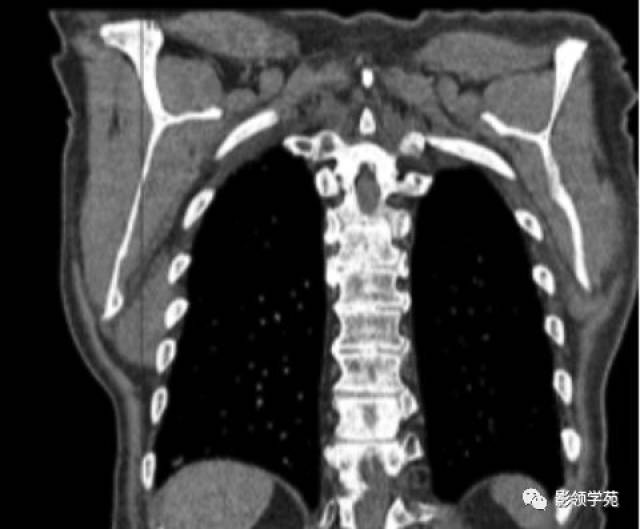 胸部ct扫描可见右肩胛下区弹性纤维瘤