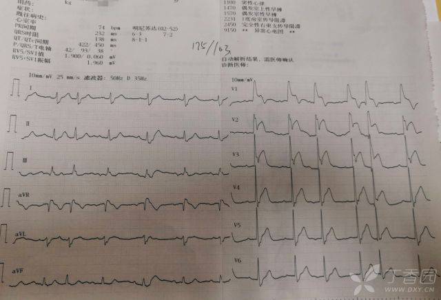 小时后复查心电图如下