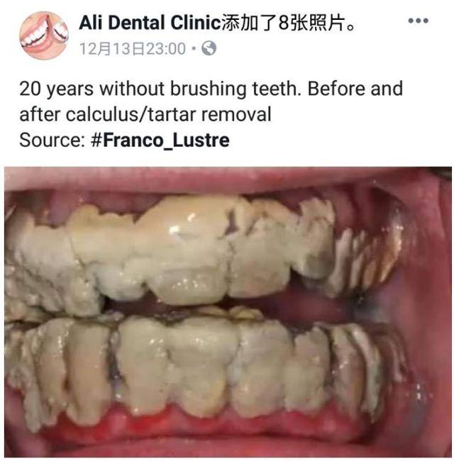 那些20年不刷牙的人,牙齿还好吗?你最长有多久没刷牙?