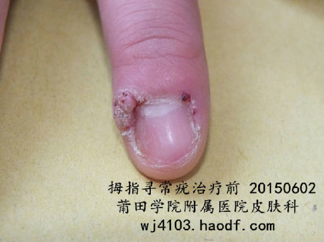 液氮冷冻治疗甲周寻常疣 (原创)