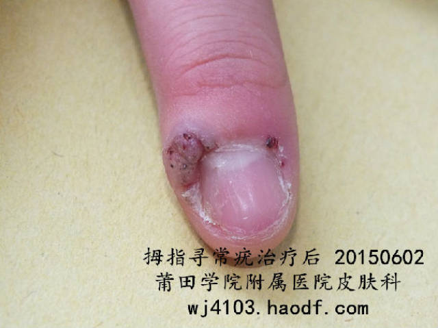 液氮冷冻治疗甲周寻常疣 (原创)