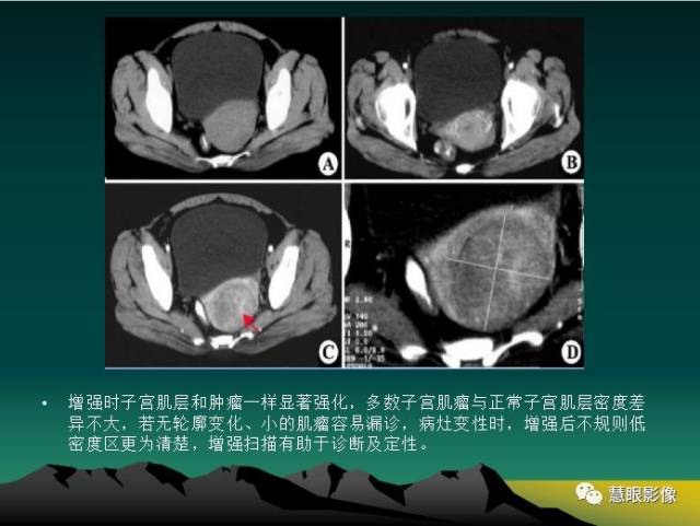 【每日一例| 753例】子宫肌瘤的影像学诊断共识