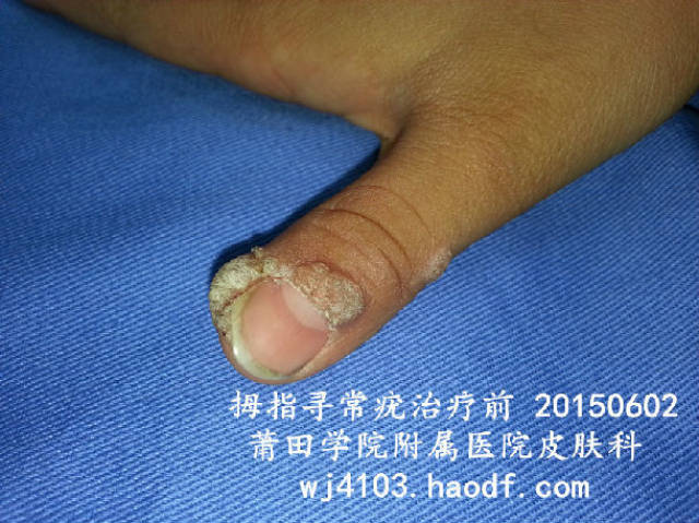 液氮冷冻治疗甲周寻常疣 (原创)