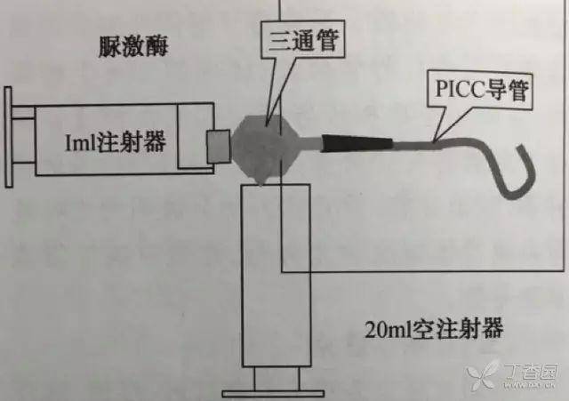 如何防堵管?