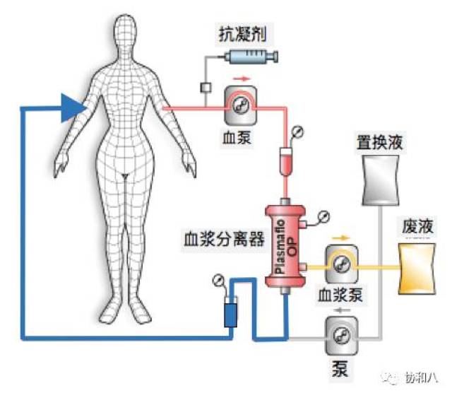 血透、血滤、血浆置换,你能分辨清楚吗?