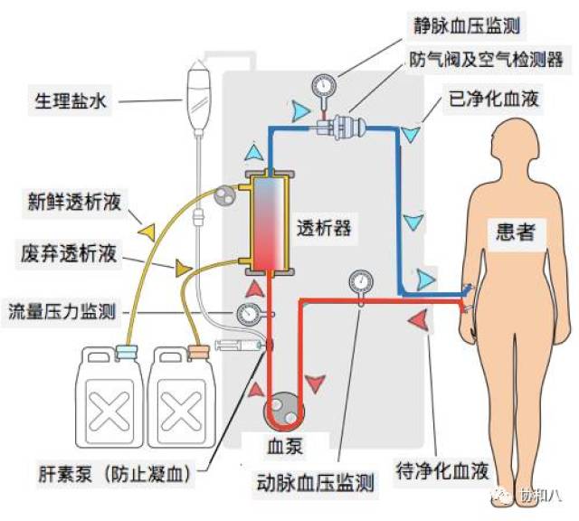 血透、血滤、血浆置换,你能分辨清楚吗?