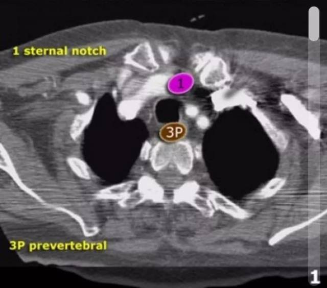 1,胸骨切迹淋巴结仅在这个层面和这个层面以上看见.