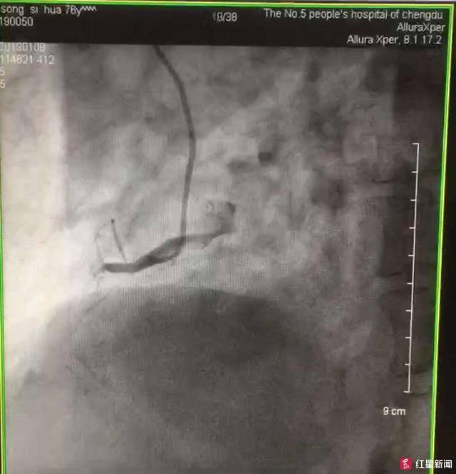 大爷心脏三根血管两根完全堵塞,"终极救命神器"打通血管保命