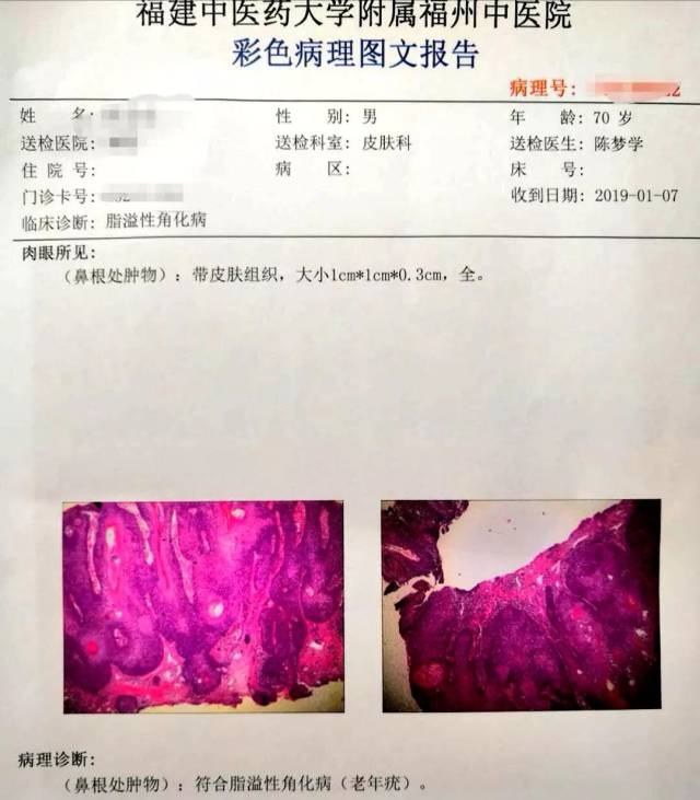 激光祛"疣"效果好,安全可靠没烦恼!