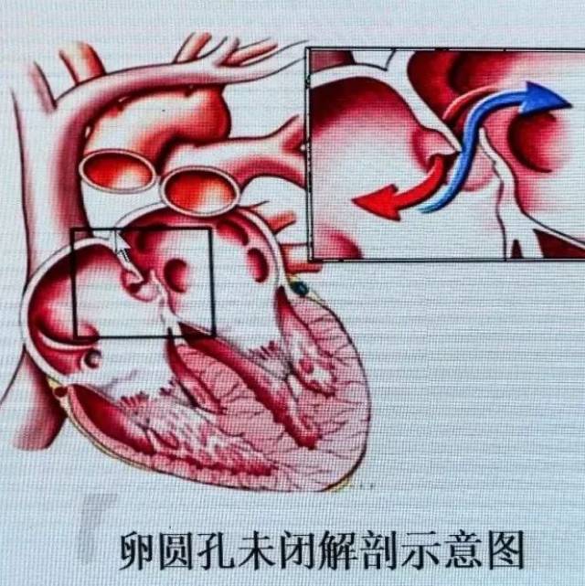 杏林轶话:43ccif2018丨张军教授:超声心动图及发泡实验与卵圆孔