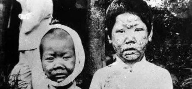 【关注】2019年1月27日 第66届“世界防治麻风病日