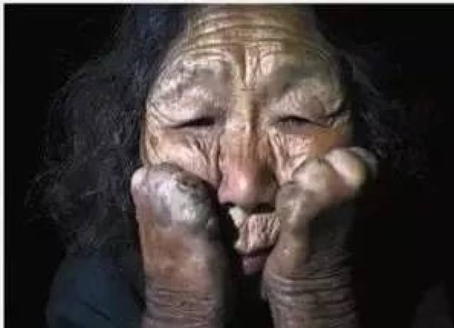 【关注】2019年1月27日 第66届“世界防治麻风病日