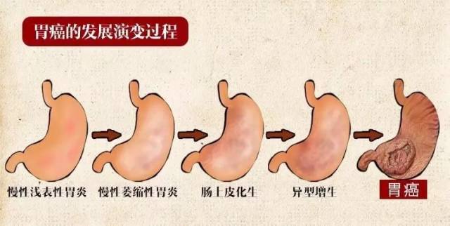 检查出了"慢性萎缩性胃炎",是不是很容易变癌?离胃癌还有多远?