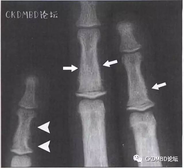 图1.shpt的手指骨骨膜下骨质吸收