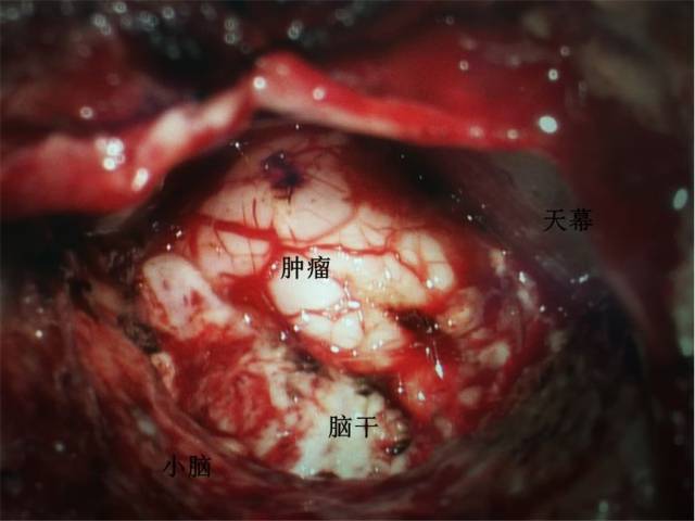 图2. 术中所见:肿瘤边界不清,质地软,血管一般,肿瘤呈弥漫性生长.