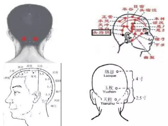 玉枕窍在脑后,位于脑后枕骨粗隆上的凹陷处(从百会穴向后下方摸,第一