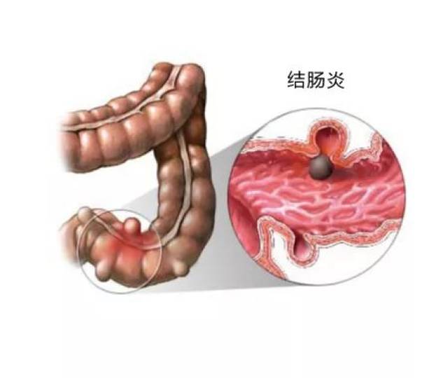 怎么判断是不是肠炎？