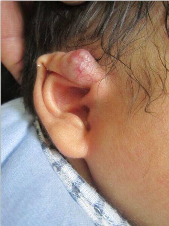 宝宝的耳朵长了血管瘤怎么办?耳部血管瘤怎么治疗?